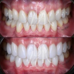 ブラックフィルムの症例 ビフォーアフター