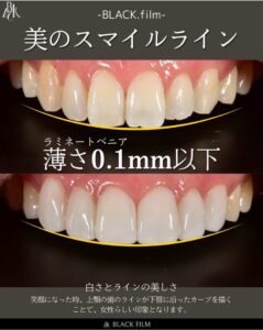 審美治療何が正解？ミニッシュとブラックフィルムの違いについて