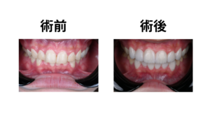 噛み合わせが深い人のブラックフィルム症例イメージ・改善例