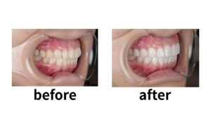 ブラックフィルム ビフォーアフター