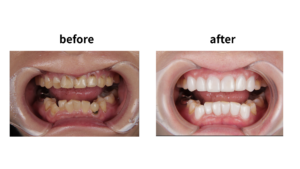 ブラックフィルムビフォーアフター