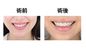 ブラックフィルム ビフォーアフター