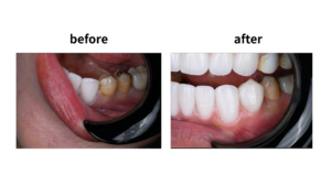 ブラックフィルム ビフォーアフター