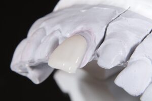 ラミネートベニアとは