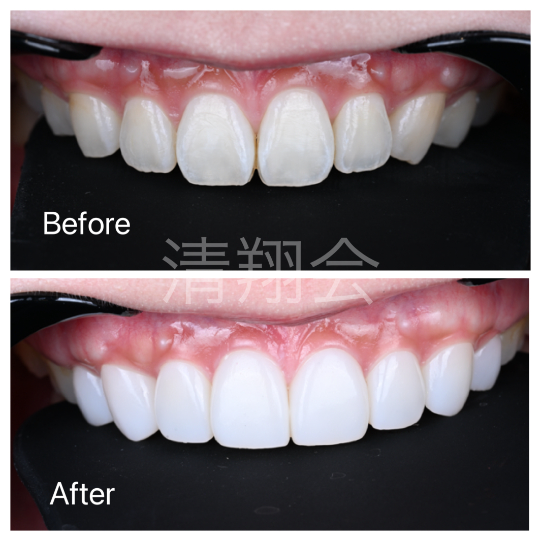 binksブラックフィルムの症例　No.２　No.3