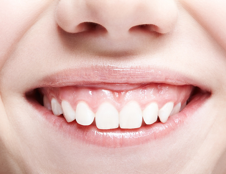 ガミースマイル