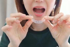 マウスピース矯正