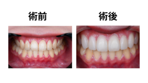 ブラックフィルムの仕上がりイメージ