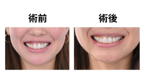 噛み合わせ矯正治療のメリット