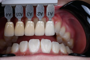 ホワイトコートだけでなくブラックフィルムもおすすめ