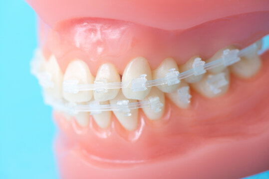 歯列矯正